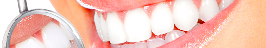 Porcelain Veneers