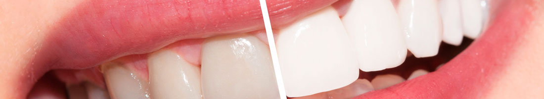 Zoom Whitening